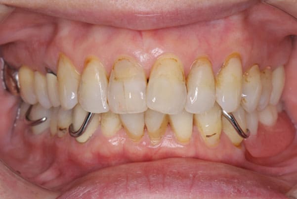 治療前の口腔内