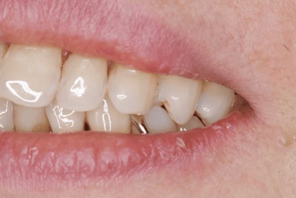 治療前の斜めからの口元