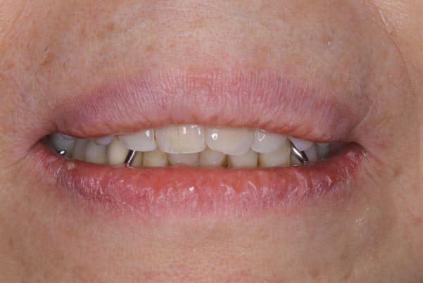 義歯が合わず痛い、見た目も気になる治療前