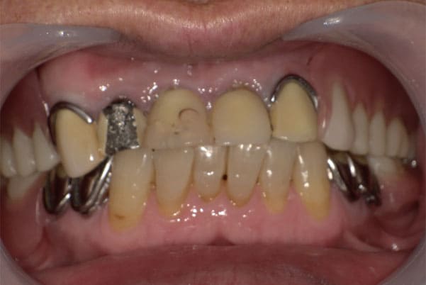 義歯がカパカパして痛い、歯がぐらぐらする治療前