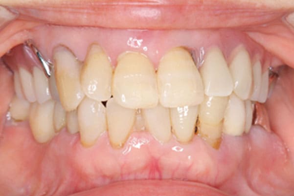 入れ歯が外れる、見た目も改善したい治療後