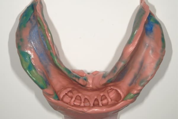 前歯がとれて痛い、食事もできず、見た目も悪いの精密な型どり