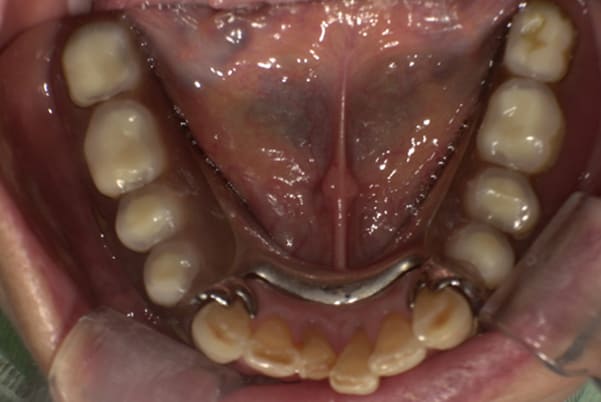 前歯がとれて痛い、食事もできず、見た目も悪いの下顎咬合面治療前