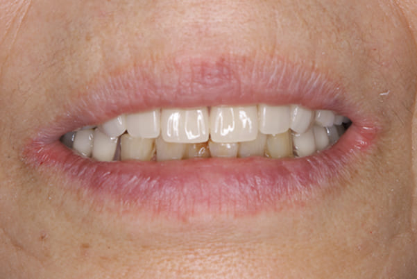 前歯がとれて痛い、食事もできず、見た目も悪いの精密義歯