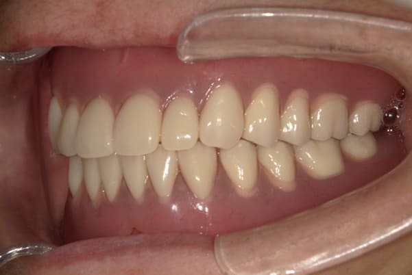 食事ができるようになりたい 左側面治療後