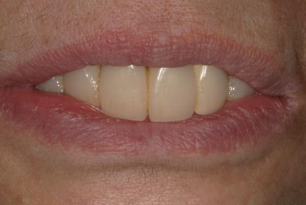 食事ができるようになりたい 治療前の口元
