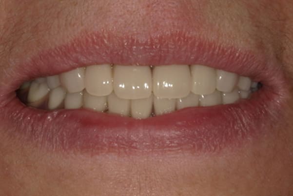 食事ができるようになりたい 治療後の口元