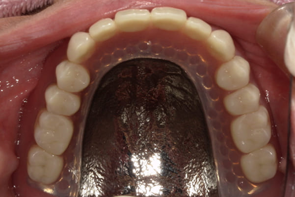 食事ができるようになりたい 上顎治療後