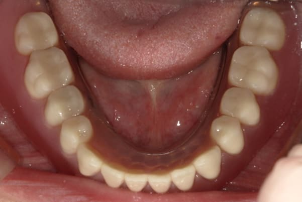 食事ができるようになりたい 下顎治療後
