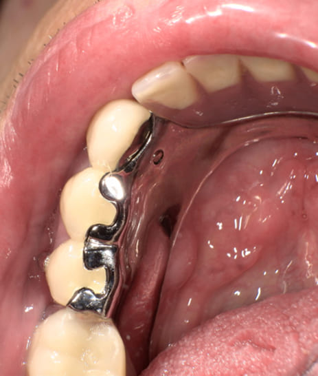 陶材焼着付鋳造冠ミリングラべット加工治療後