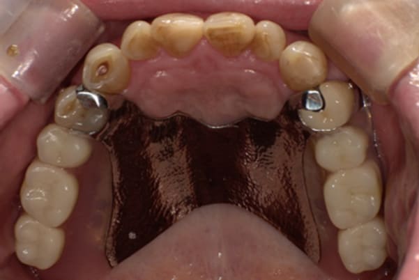治療後に入れ歯を装着した上顎