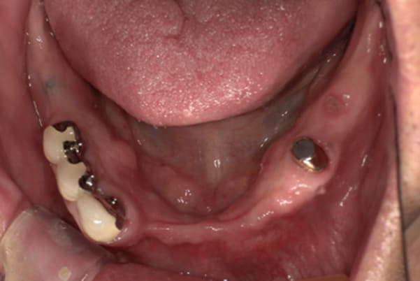 治療後に入れ歯を外した下顎