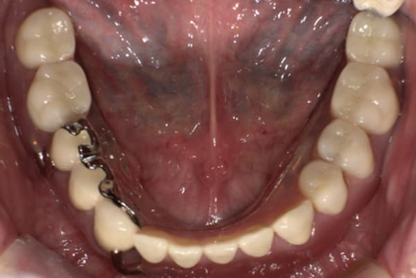 治療後に入れ歯を装着した下顎