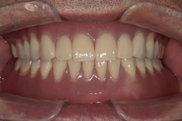 娘とハンバーガーを食べたい治療後