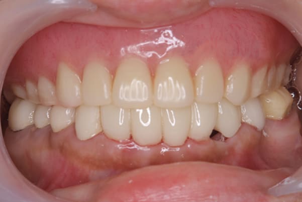 娘に勧められ治療を決心の治療途中