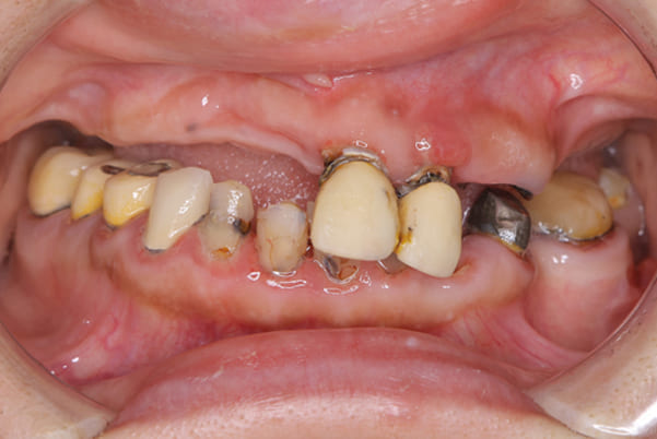 娘に勧められ治療を決心の治療前