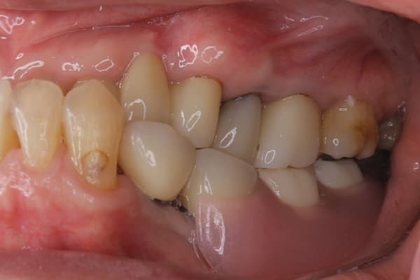 義歯が浮く、硬いものを食べると痛い治療後