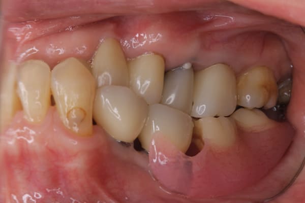 義歯が浮く、硬いものを食べると痛い治療前