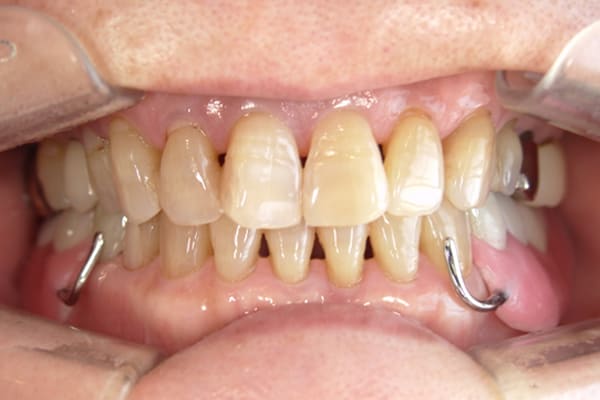 色んな歯医者で何度も作ったが咬めない治療後