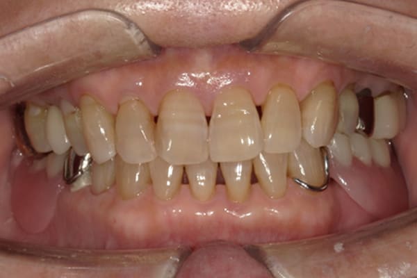 色んな歯医者で何度も作ったが咬めない治療前