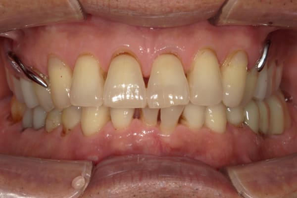 違和感なく安定剤なしで話せて、食べられる入れ歯を治療後