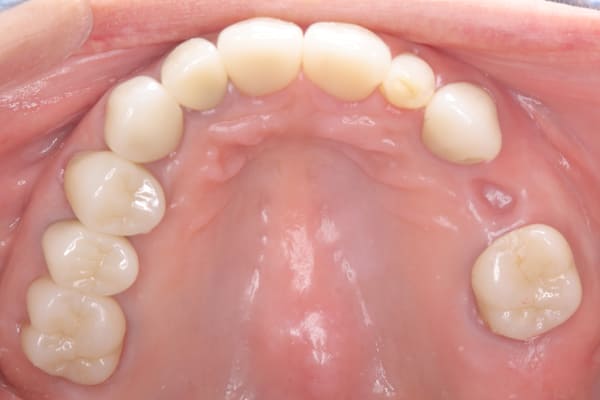 治療後(入れ歯作製前)