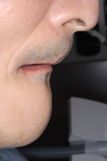 入れ歯がない状態