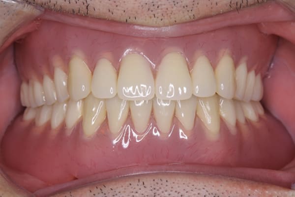 ほとんどの歯がぐらぐらして咬めない治療後