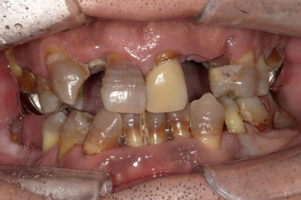 ほとんどの歯がぐらぐらして咬めない治療前