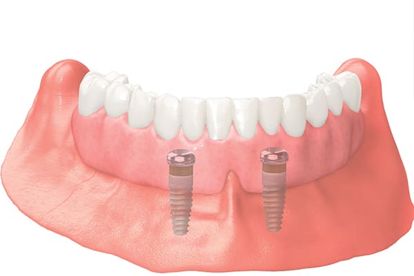 インプラント入れ歯